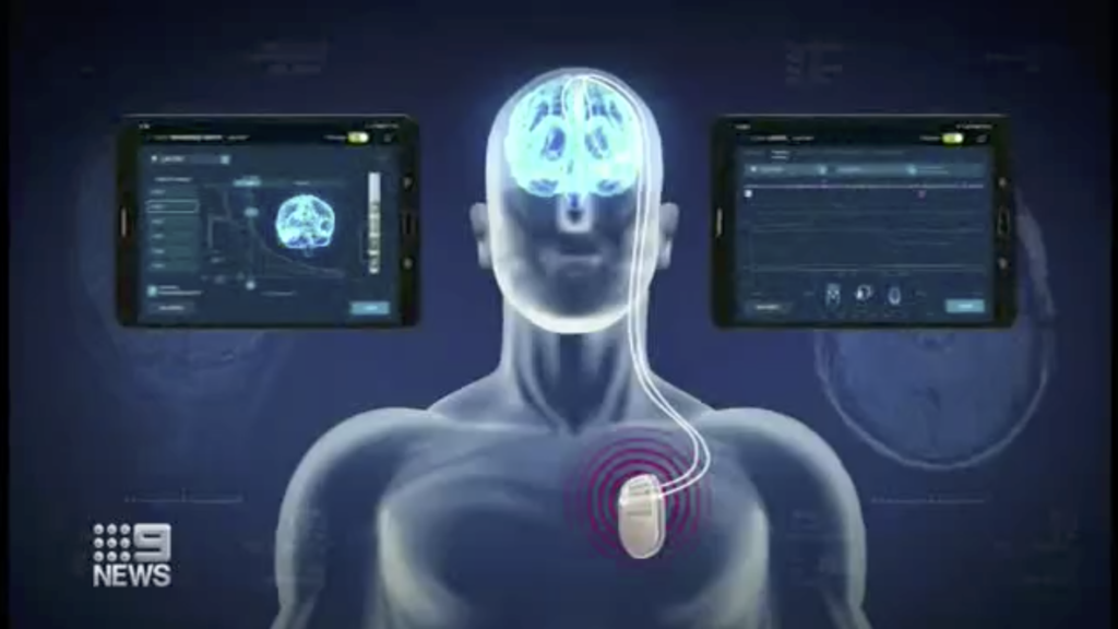 Deep Brain Stimulation: New technology in the treatment of Parkinson’s Disease